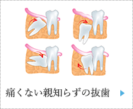 )痛くない親知らずの抜歯