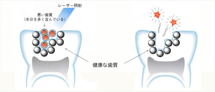 削らない虫歯治療