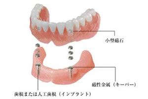 磁性アタッチメント義歯