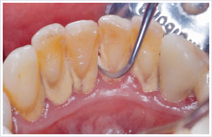 歯のスケーリング（軽度歯周病の方対象）