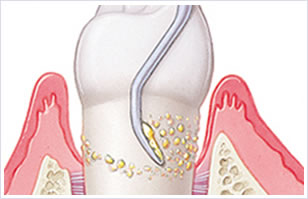 歯のルートプレーニング（中等度歯周病の方対象）
