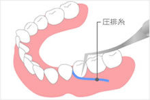 圧排糸の使用