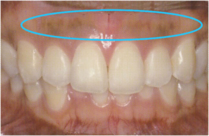 歯肉のホワイトニング治療前